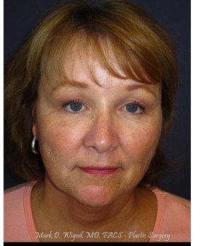 Facial Rejuventation – Browlift