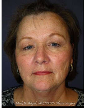 Facial Rejuventation – Browlift