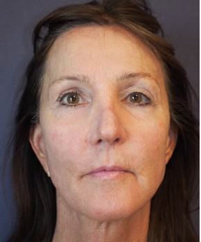 After Image: Facial Rejuvenation – Facelift - front
