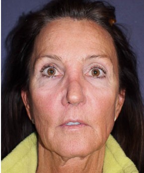Before Image: Facial Rejuvenation – Facelift - front