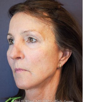 After Image: Facial Rejuvenation – Facelift - other