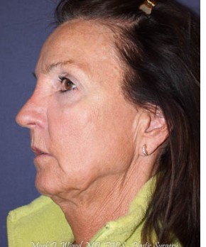Before Image: Facial Rejuvenation – Facelift - other