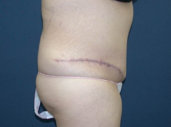 Abdominoplasty