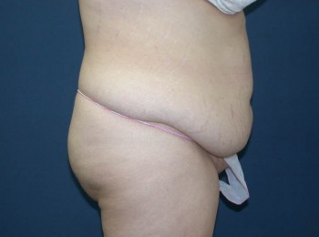 Abdominoplasty