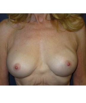 Breast Augmentation Revision