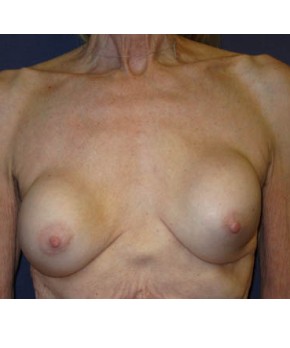 Breast Augmentation Revision