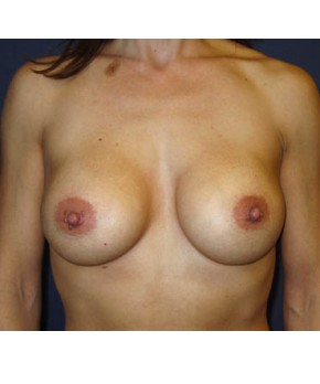 Breast Augmentation Revision