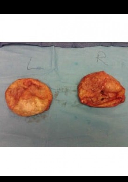 Breast Augmentation Revision