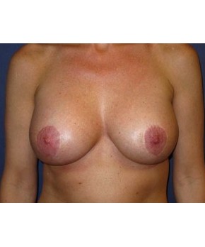 Breast Augmentation Mastopexy  – Staged