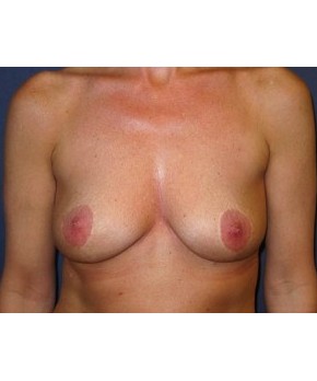 Breast Augmentation Mastopexy  – Staged