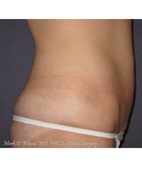 Mini Abdominoplasty