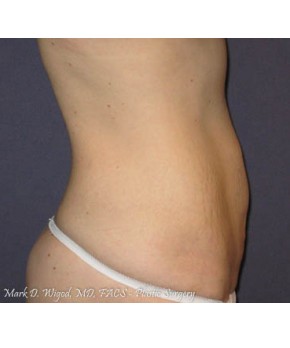 Mini Abdominoplasty