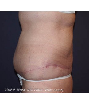 Massive Weight Loss – Abdominoplasty and Lateral Thigh Lift