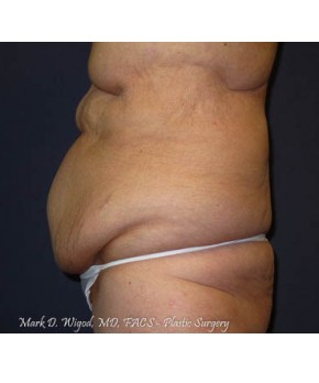 Massive Weight Loss – Abdominoplasty and Lateral Thigh Lift