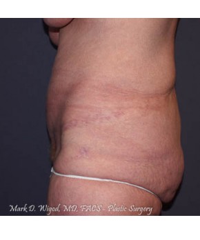 Massive Weight Loss – Abdominoplasty