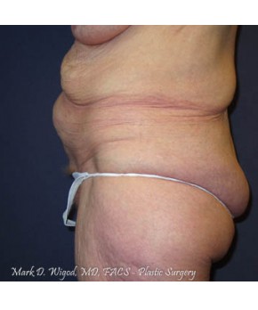 Massive Weight Loss – Abdominoplasty