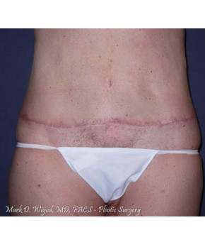 Abdominoplasty Revision and Back Lift