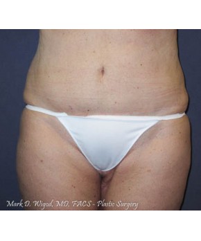 Abdominoplasty Revision and Back Lift