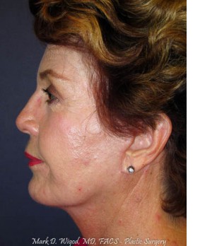 After Image: Facial Rejuvenation – Facelift, Chin Implant, and Fat Grafting - left-side