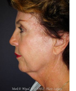 Before Image: Facial Rejuvenation – Facelift, Chin Implant, and Fat Grafting - left-side