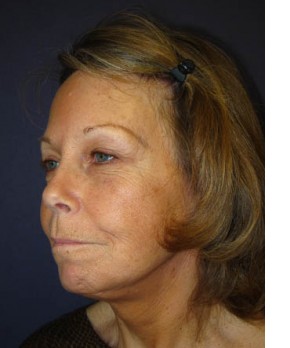 After Image: Facial Rejuvenation – Facelift and Browlift - left-front-oblique