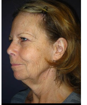 Before Image: Facial Rejuvenation – Facelift and Browlift - left-front-oblique