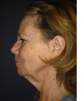 Facial Rejuvenation – Facelift and Browlift