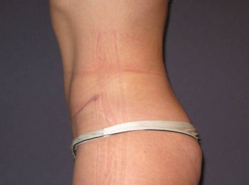 Mini Abdominoplasty with Flank Liposuction