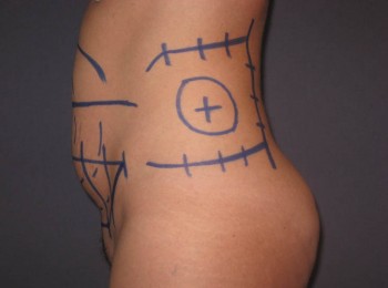 Mini Abdominoplasty with Flank Liposuction