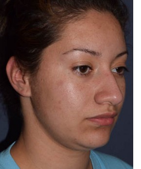 Before Image: Rhinoplasty – Closed - other