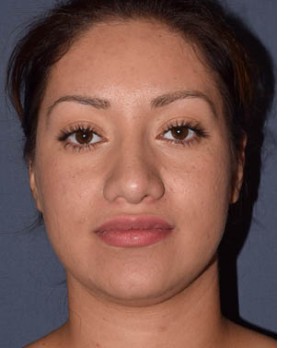After Image: Rhinoplasty – Closed - front