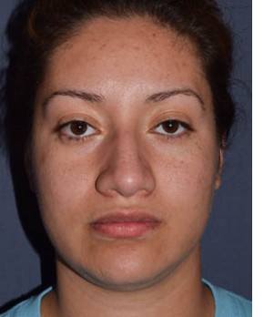 Before Image: Rhinoplasty – Closed - front