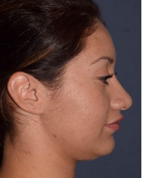 After Image: Rhinoplasty – Closed - other
