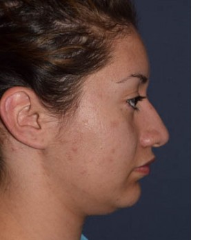 Before Image: Rhinoplasty – Closed - other