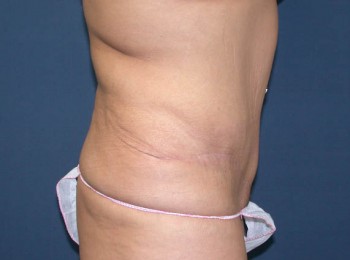 Massive Weight Loss – Abdominoplasty