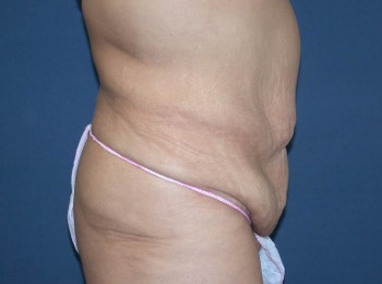 Massive Weight Loss – Abdominoplasty