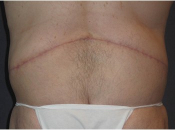After Image: Massive Weight Loss – Abdominoplasty and Lateral Thigh Lift - back