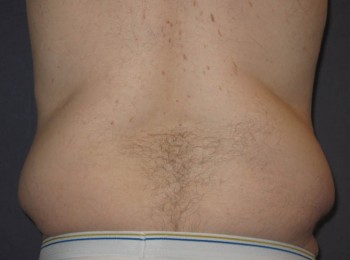 Before Image: Massive Weight Loss – Abdominoplasty and Lateral Thigh Lift - back