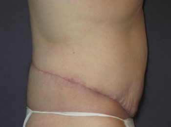 Massive Weight Loss – Abdominoplasty and Lateral Thigh Lift