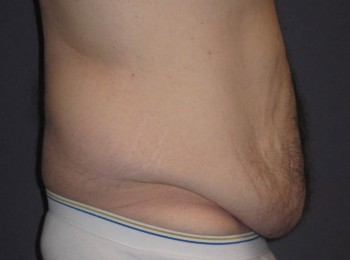 Massive Weight Loss – Abdominoplasty and Lateral Thigh Lift