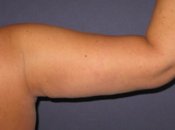 Massive Weight Loss – Brachioplasty
