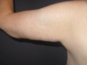 Massive Weight Loss – Brachioplasty