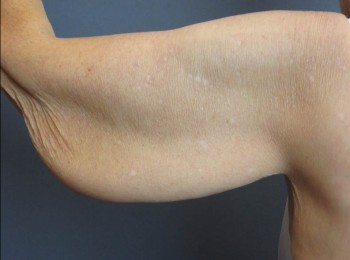 Massive Weight Loss – Brachioplasty
