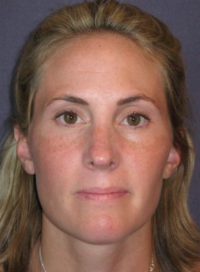 Rhinoplasty – Open