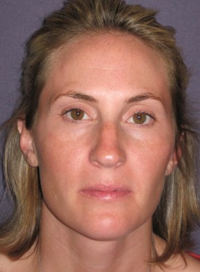 Rhinoplasty – Open