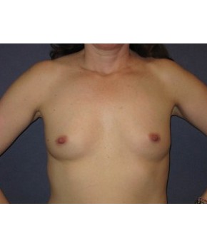 Before Image: Breast Augmentation Before Pregnancy - front