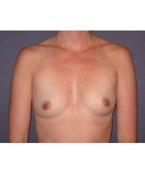 Before Image: Breast Augmentation Before Pregnancy - front
