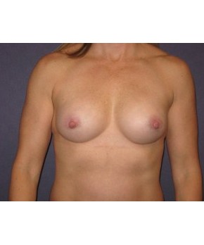 After Image: Breast Augmentation – Body Builder / Fitness - front