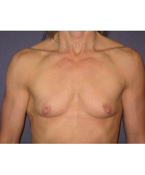 Before Image: Breast Augmentation – Body Builder / Fitness - front