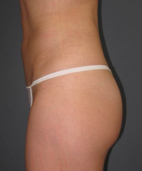 Liposuction